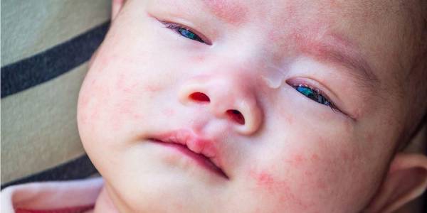 batuk alergi pada anak