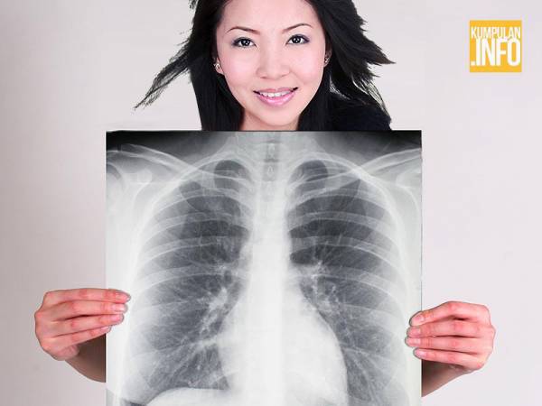 Penyakit paru-paru yang disebabkan oleh mycobacterium tuberculosis disebut